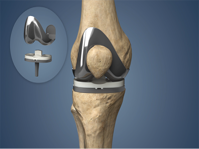 best Knee Replacement Surgeon in Pune